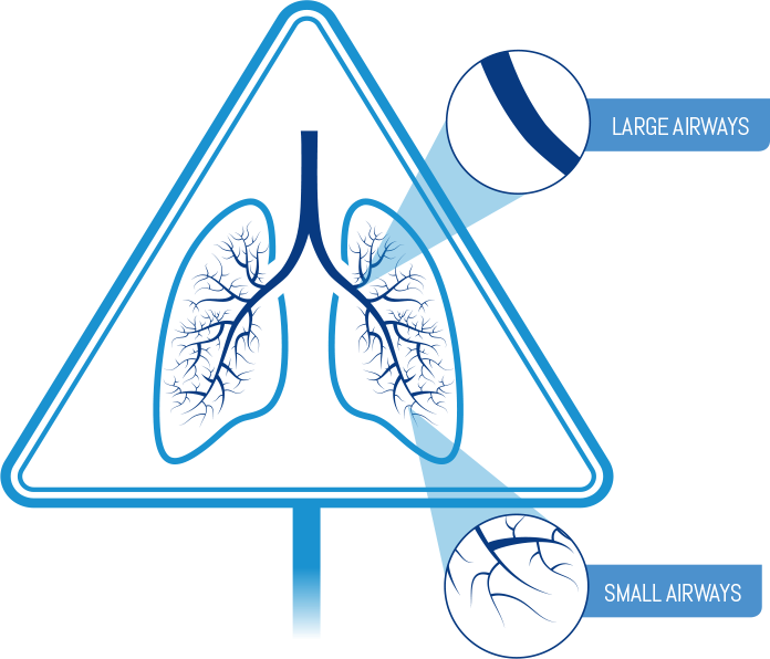 Diagram showing distinction between large and small airways